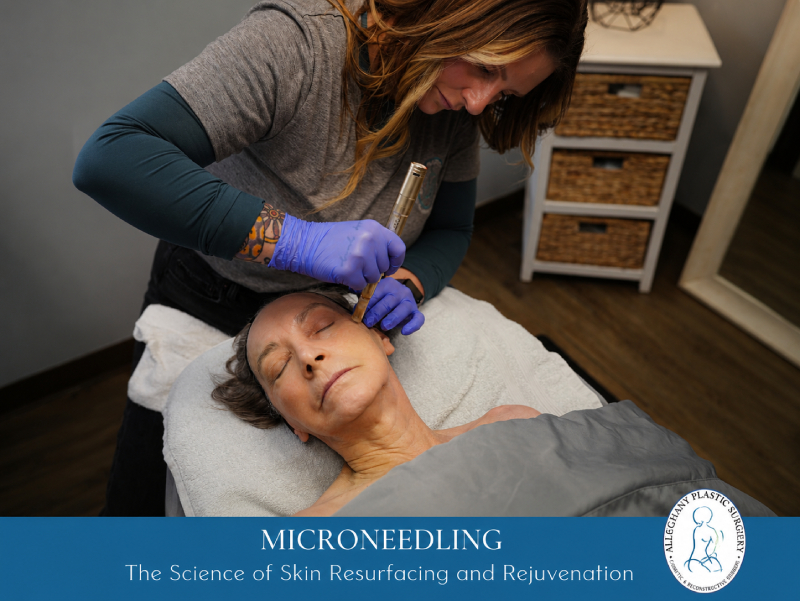 Microneedling – The Science of Skin Resurfacing and Rejuvenation