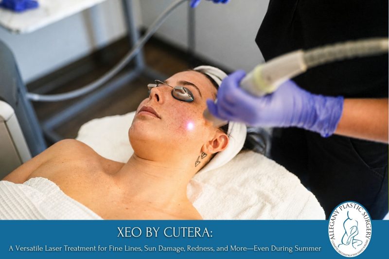 XEO by Cutera A Versatile Laser Treatment for Fine Lines, Sun Damage, Redness, and More—Even During Summer