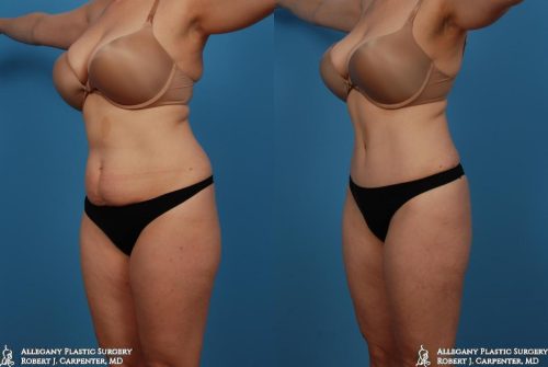 21.-Abdominoplasty-smart-liposuction-of-bilateral-flanks-lateral-thighs-and-upper-inner-thighs-B