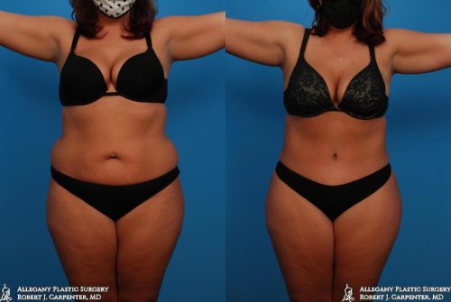 34.-Abdominoplasty-bilateral-flank-liposuction-A