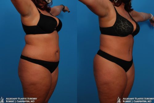 34.-Abdominoplasty-bilateral-flank-liposuction-B