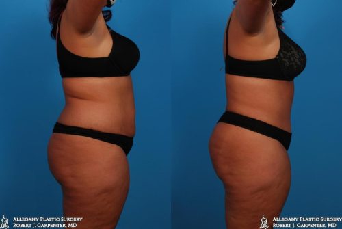 34.-Abdominoplasty-bilateral-flank-liposuction-C
