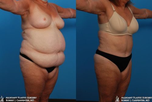 35.-Large-volume-liposuction-of-the-abdomen-and-flanks-followed-later-by-Abdominoplasty-B