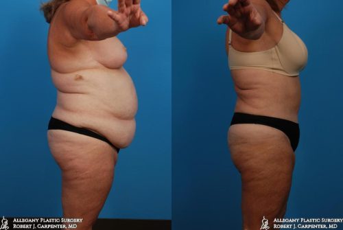 35.-Large-volume-liposuction-of-the-abdomen-and-flanks-followed-later-by-Abdominoplasty-C