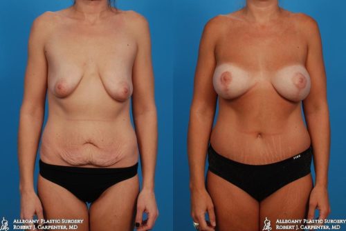36.-Abdominoplasty-bilateral-augmentation-with-moderate-plus-300cc-implants-and-mastopexy-A