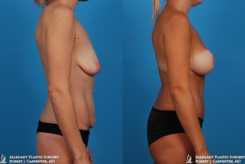 36.-Abdominoplasty-bilateral-augmentation-with-moderate-plus-300cc-implants-and-mastopexy-C