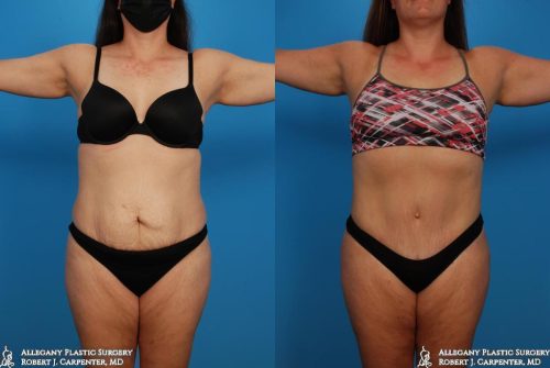 37.-Abdominoplasty-bilateral-flank-liposuction-A