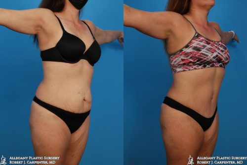 37.-Abdominoplasty-bilateral-flank-liposuction-B