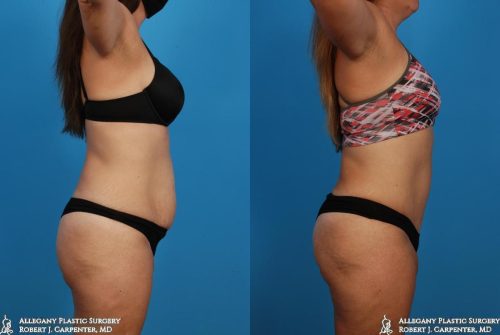 37.-Abdominoplasty-bilateral-flank-liposuction-C