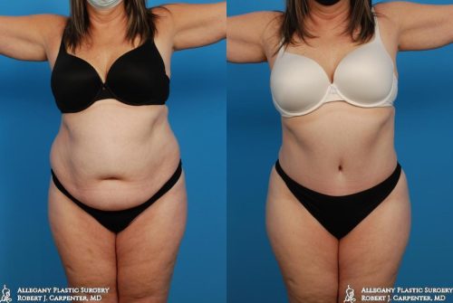 38.-Abdominoplasty-bilateral-flank-liposuction-A