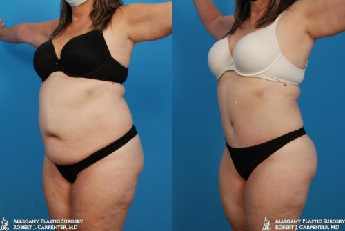 38.-Abdominoplasty-bilateral-flank-liposuction-B