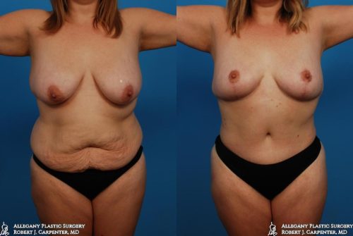 39.-Bilateral-flank-liposuction-abdominoplasty-and-mastopexy-A