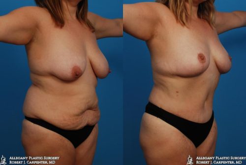 39.-Bilateral-flank-liposuction-abdominoplasty-and-mastopexy-B