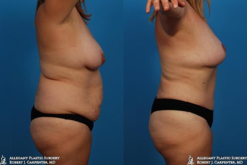 39.-Bilateral-flank-liposuction-abdominoplasty-and-mastopexy-C
