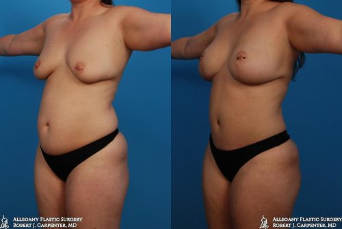 40.-Bilateral-flank-liposuction-axillary-liposuction-abdominoplasty-and-breast-augmentation-with-moderate-plus-275cc-B