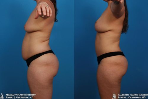 40.-Bilateral-flank-liposuction-axillary-liposuction-abdominoplasty-and-breast-augmentation-with-moderate-plus-275cc-C