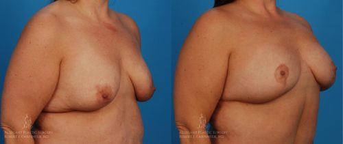 Breast-Lift-Patient-19-2-1