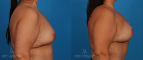 Breast-Lift-Patient-19-3-1